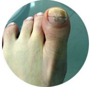 Wrastające paznokcie